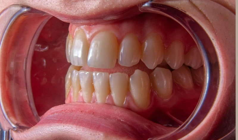 retractie gingivala